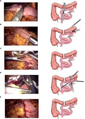 Effectiveness and safety of self-pulling and latter transection reconstruction in totally laparoscopic right hemicolectomy
